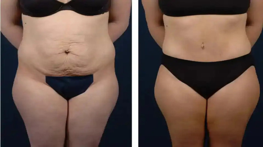 Comparing Mini Tummy Tuck and Full Tummy Tuck in Dubai - ZeShare