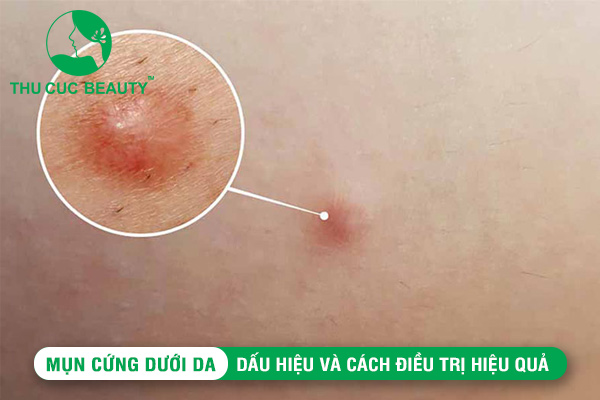 Mụn cứng dưới da: Dấu hiệu và cách điều trị hiệu quả