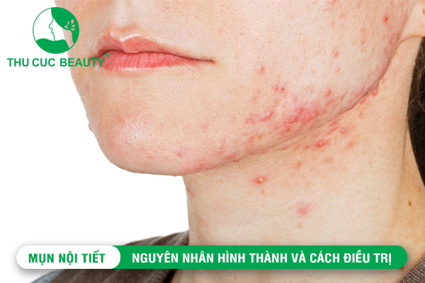 Mụn nội tiết: Nguyên nhân hình thành và cách điều trị