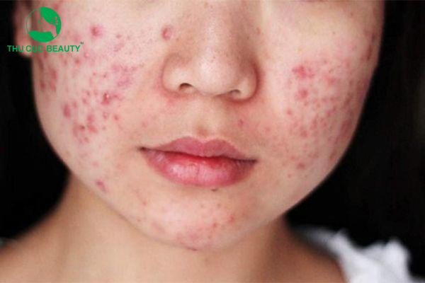 Tiêm filler bị nổi mụn có nguy hiểm không?