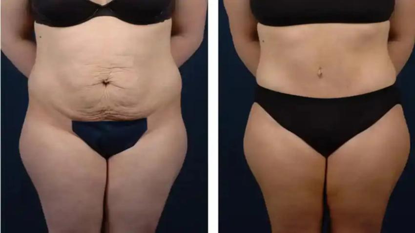 Comparing Traditional Tummy Tuck Techniques With Modern Advancements - written by Plastic Surgery on Sociomix