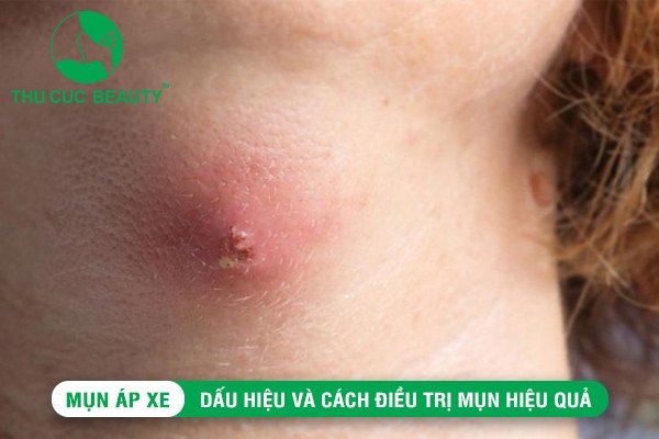 Mụn áp xe: Dấu hiệu và cách điều trị mụn hiệu quả