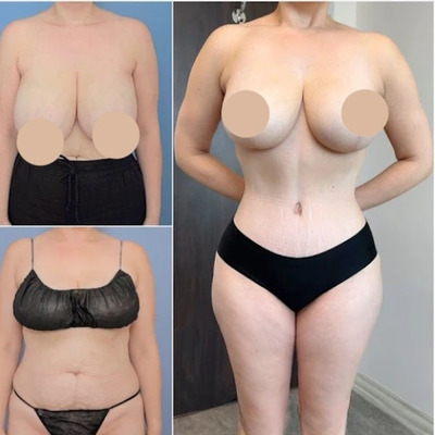 Lifestyle Changes to Maintain Your Tummy Tuck Results -  Blog Article By Perfect Doctors Clinic
