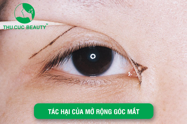 Tác hại của mở rộng góc mắt và cách phòng ngừa