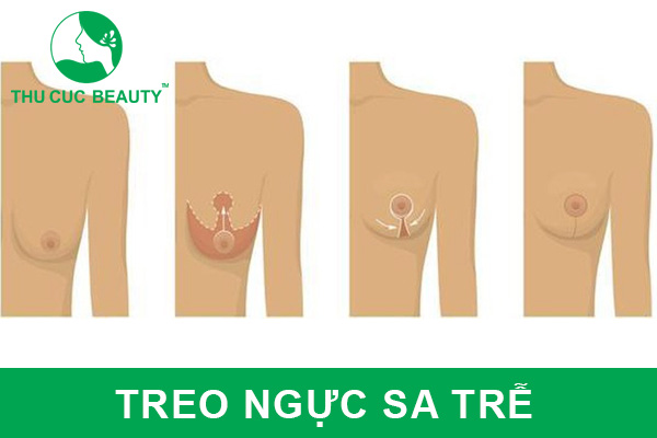 Treo ngực sa trễ: Phương pháp hữu hiệu mang lại sự tự tin