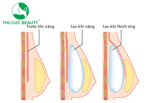 Nâng ngực là gì? Các phương pháp nâng ngực hiện nay - Bệnh viện Thẩm Mỹ Thu Cúc