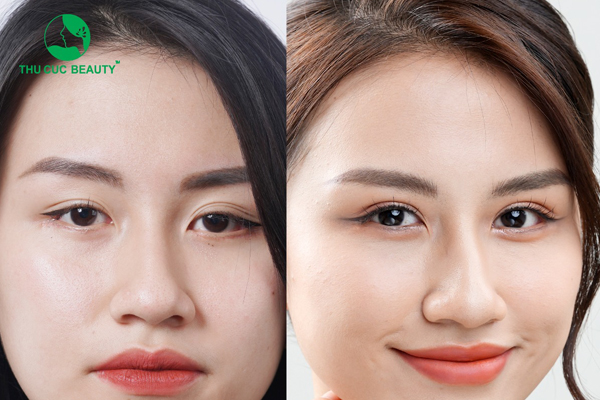 Chỉnh hình sụp mí: Phương pháp an toàn, hiệu quả cao