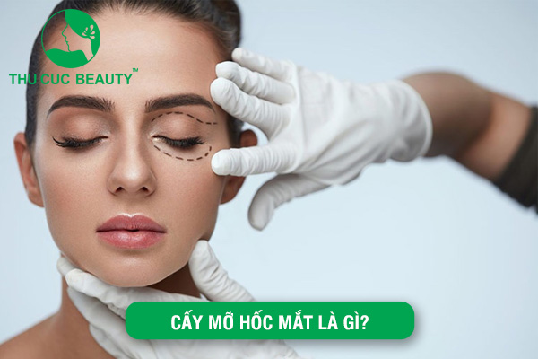 Cấy mỡ hốc mắt: Những điều cần biết về phương pháp