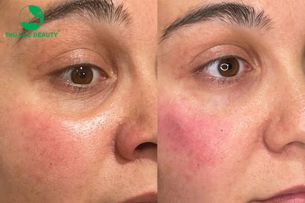 Xóa rãnh lệ: Đánh thức vẻ đẹp trẻ trung, tự nhiên