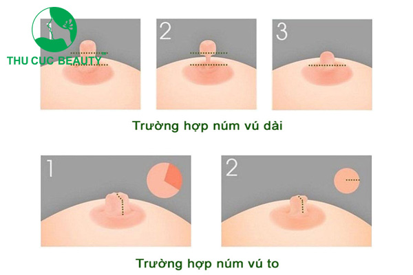 Thu nhỏ đầu vú: Giải pháp cho đầu ngực nhỏ gọn, quyến rũ