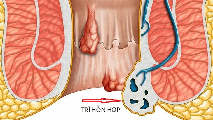 Nhận biết dấu hiệu trĩ hỗn hợp bằng cách nào?