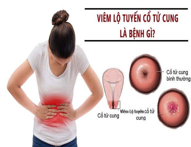 Làm sao để nhận biết đúng dấu hiệu viêm lộ tuyến cổ tử cung?