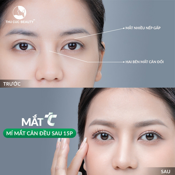 Thẩm Mỹ Mắt | Cắt Mí | Nhấn Mí | Tạo Hình Mí Mắt | Mắt TC