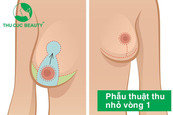 Phẫu thuật thu nhỏ ngực (vòng 1) phì đại - BVTM Thu Cúc