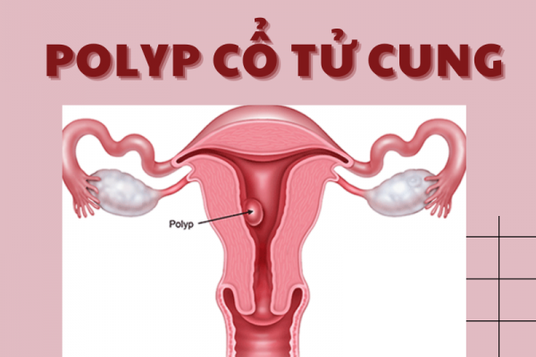 Polyp cổ tử cung: Dấu hiệu nhận biết và phương pháp điều trị