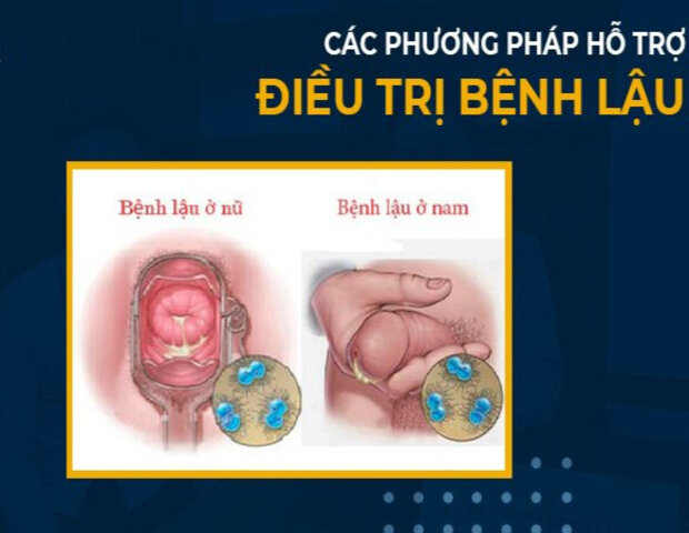 Phương pháp nào điều trị bệnh lậu hiệu quả nhất?