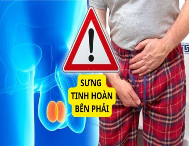 Tình trạng sưng bìu bên phải do những nguyên nhân nào gây ra?