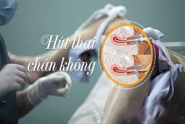 Hút thai chân không - Phương pháp đình chỉ thai an toàn