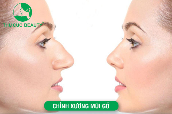 Chỉnh Xương Mũi Gồ - Phương Pháp Sửa Mũi Gồ An Toàn