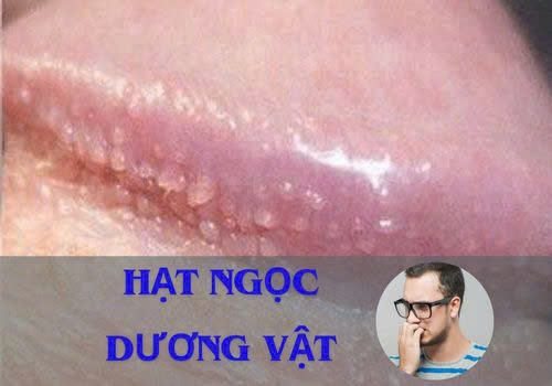 Hạt ngọc dương vật ở nam giới là bệnh gì? Có nguy hiểm không?