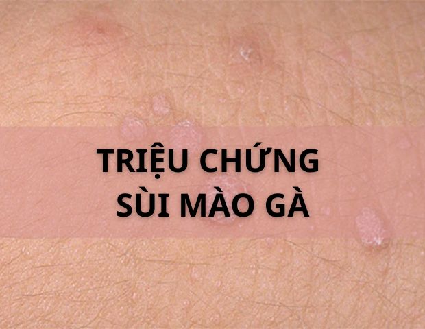 Nhận biết triệu chứng sùi mào gà qua từng giai đoạn