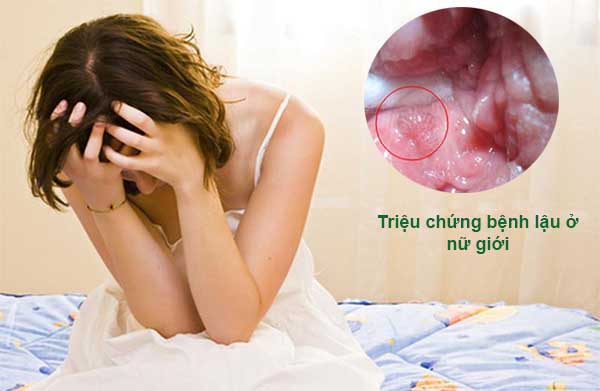 Cách phát hiện sớm triệu chứng bệnh lậu ở nữ giới