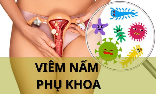 Viêm nấm phụ khoa: Những lưu ý khi điều trị mà chị em nên bỏ túi