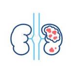 Kidney Cancer