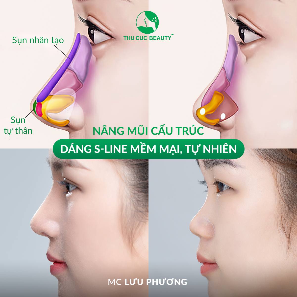 Nâng mũi cấu trúc  - Bệnh viện Thẩm mỹ Thu Cúc