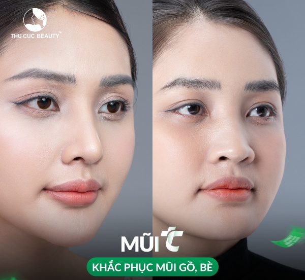 Thu gọn xương mũi bè - Bệnh viện Thẩm mỹ Thu Cúc