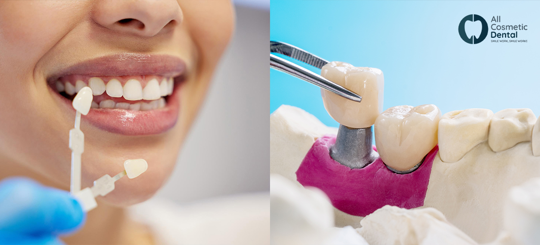 Difference Between Veneers and Crowns