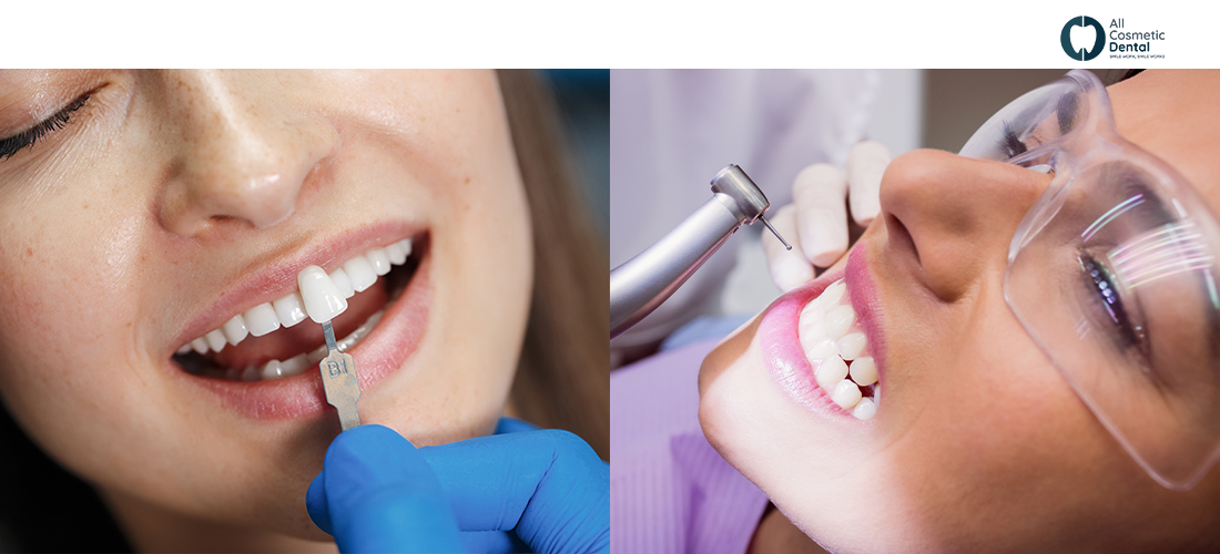 Porcelain VS Composite Veneers: A Detailed Guide