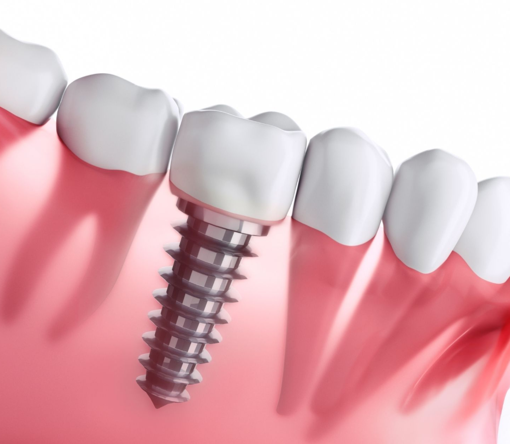 Get Quality Assured Dental Implants in Dubai at Healway