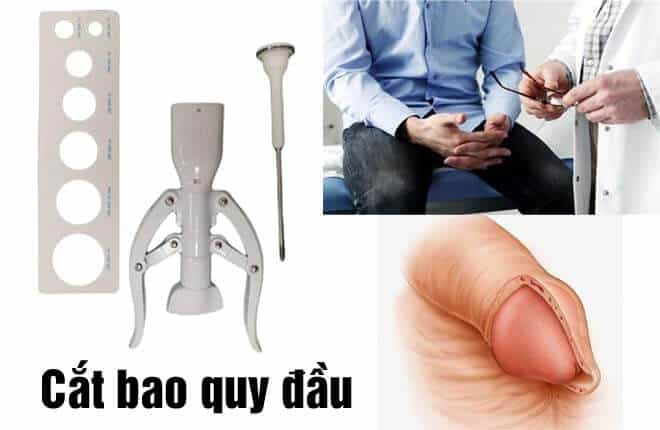 Cắt bao quy đầu có đau không?