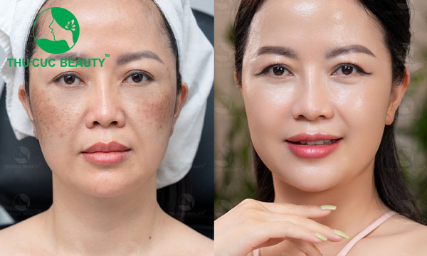 Trị nám TC: Giải pháp hiệu quả nhất hiện nay - Bệnh viện Thẩm mỹ Thu Cúc