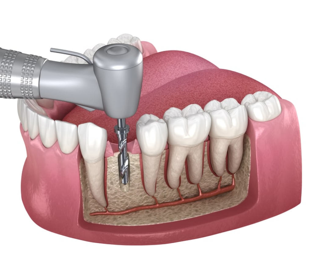 Find the Best Root Canal Treatment in Dubai at Healway Medical Center
