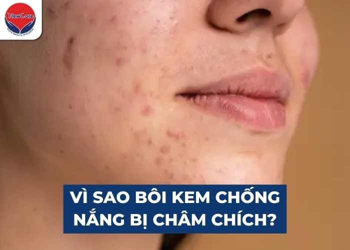 Bôi kem chống nắng bị châm chích – Nguyên nhân & cách khắc phục - Newcare - Mỹ phẩm Nhật Bản cao cấp