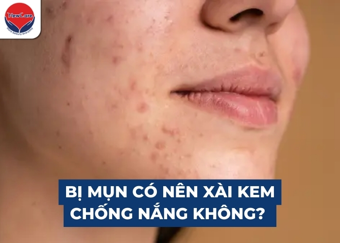 Bị mụn có nên xài kem chống nắng? Bí quyết chọn an toàn & hiệu quả - Newcare - Mỹ phẩm Nhật Bản cao cấp