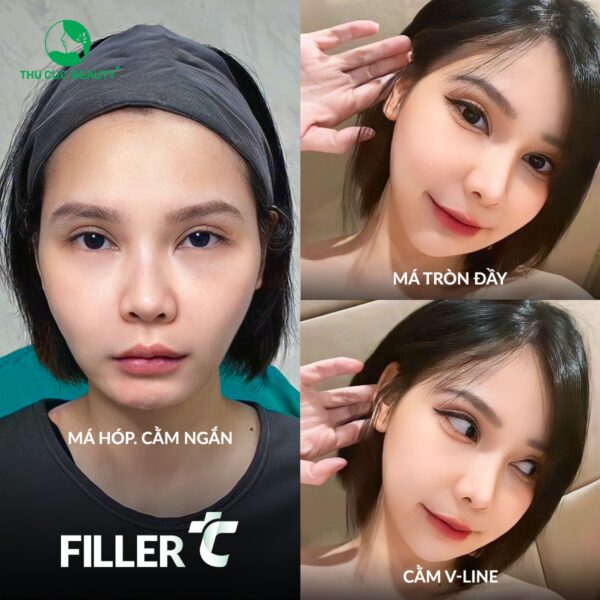 Giá tiêm filler hiện nay là bao nhiêu? - Bệnh viện Thẩm mỹ Thu Cúc