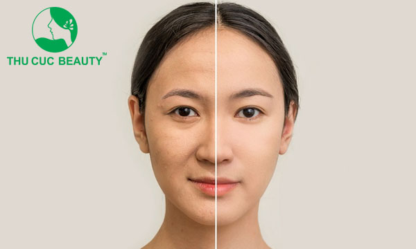 So sánh cấy HA collagen và tiêm filler khác nhau như thế nào? - Bệnh viện Thẩm mỹ Thu Cúc