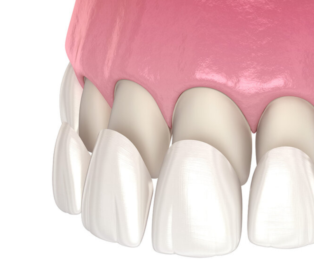 Find Premium Quality and Durable Dental Veneers in Dubai at Healway