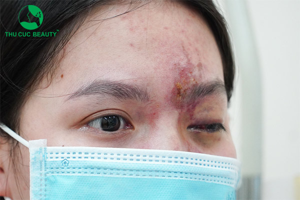 Cảnh báo tiêm filler mũi bị mù mắt - Bệnh viện Thẩm mỹ Thu Cúc