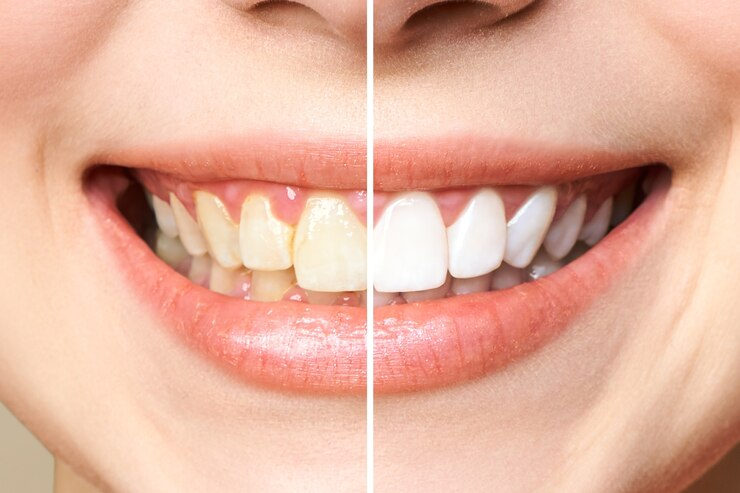 Teeth Whitening: White Your Discolored Teeth in Harrisonburg VA