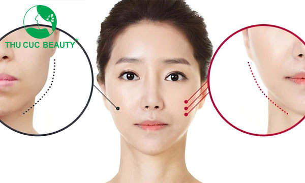 Những điều cần biết trước khi tiêm botox gọn hàm  - Bệnh viện Thẩm mỹ Thu Cúc