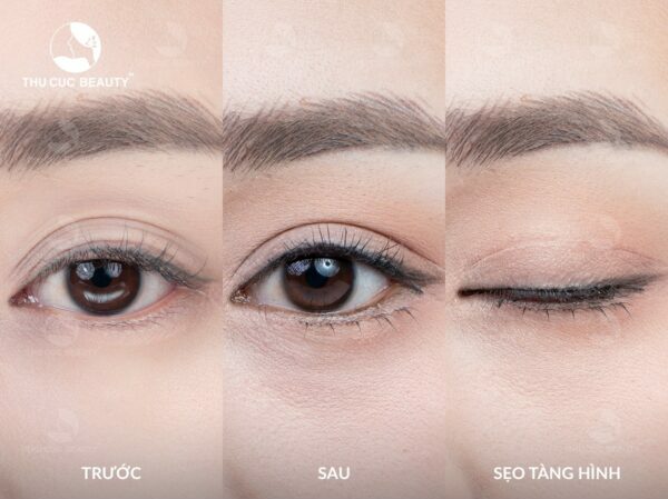 Cắt mí bao lâu thì lành? - Bệnh viện Thẩm mỹ Thu Cúc