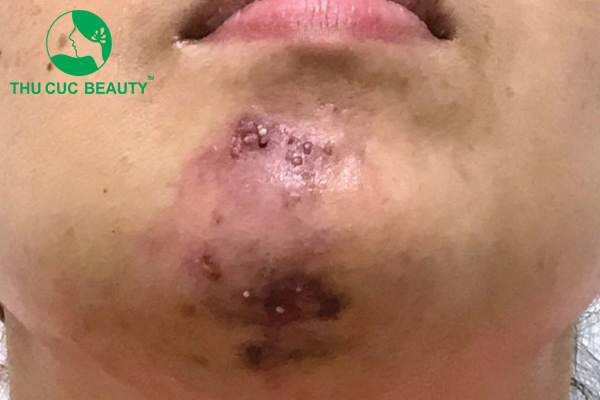 Biến chứng tiêm filler cằm: Nguyên nhân và cách khắc phục - Bệnh viện Thẩm mỹ Thu Cúc