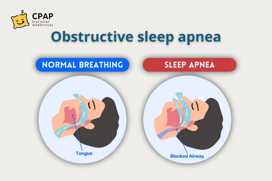 Obstructive Sleep Apnea (OSA): Symptoms, and causes