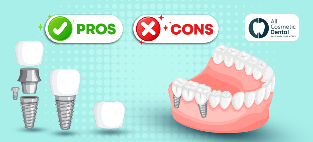 The Pros and Cons of All-On-4 Dental Implants | All Cosmetic Dental