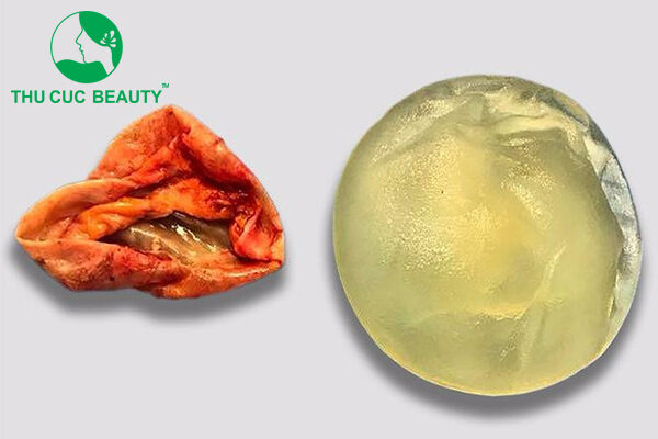 Bao xơ ngực là như thế nào? Dấu hiệu ngực bao xơ - Bệnh viện Thẩm mỹ Thu Cúc