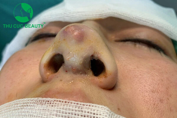 Dấu hiệu bị tụ dịch sau nâng mũi và những điều cần biết - Bệnh viện Thẩm mỹ Thu Cúc